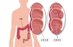 腸息肉會癌變嗎？腸鏡檢查出腸息肉千萬別大意！