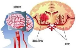 原來高血壓和腦出血有這樣的關系......高血壓別不當回事，警惕變成腦出血！