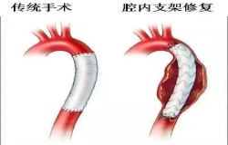 《問心》熱播！全網(wǎng)熱議的主動(dòng)脈夾層，您了解嗎？