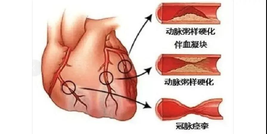 冠心病患者注意了，專業(yè)醫(yī)生為您盤點(diǎn)那些堅(jiān)決不能停的藥！